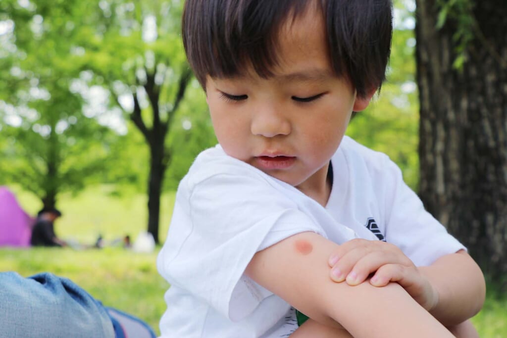 蚊に刺された幼児