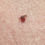 【画像】命に関わる可能性も……？　アウトドアで本当に気をつけたいマダニ対策とは 〜 画像1