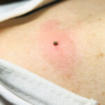 【画像】命に関わる可能性も……？　アウトドアで本当に気をつけたいマダニ対策とは 〜 画像1